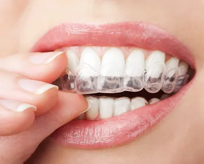 Gabinet Invisalign Warszawa. Proste zęby. Ortodonta.